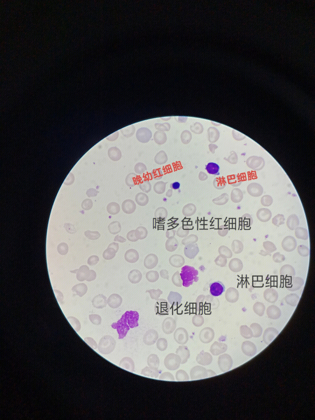 原幼淋巴细胞图片