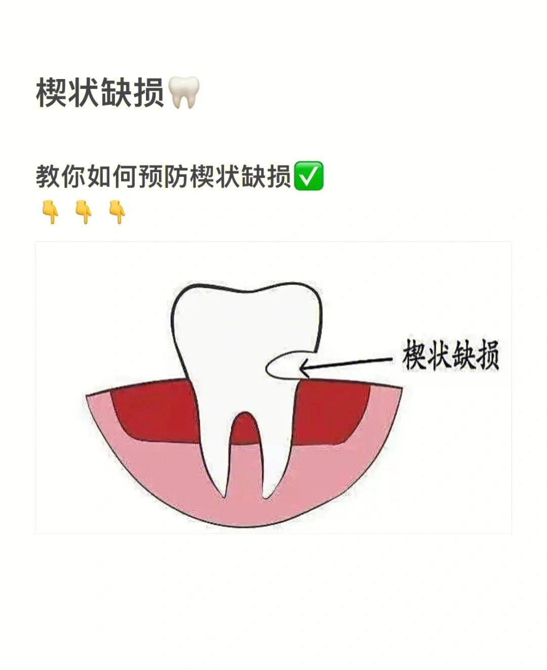 楔状缺损的原因图片