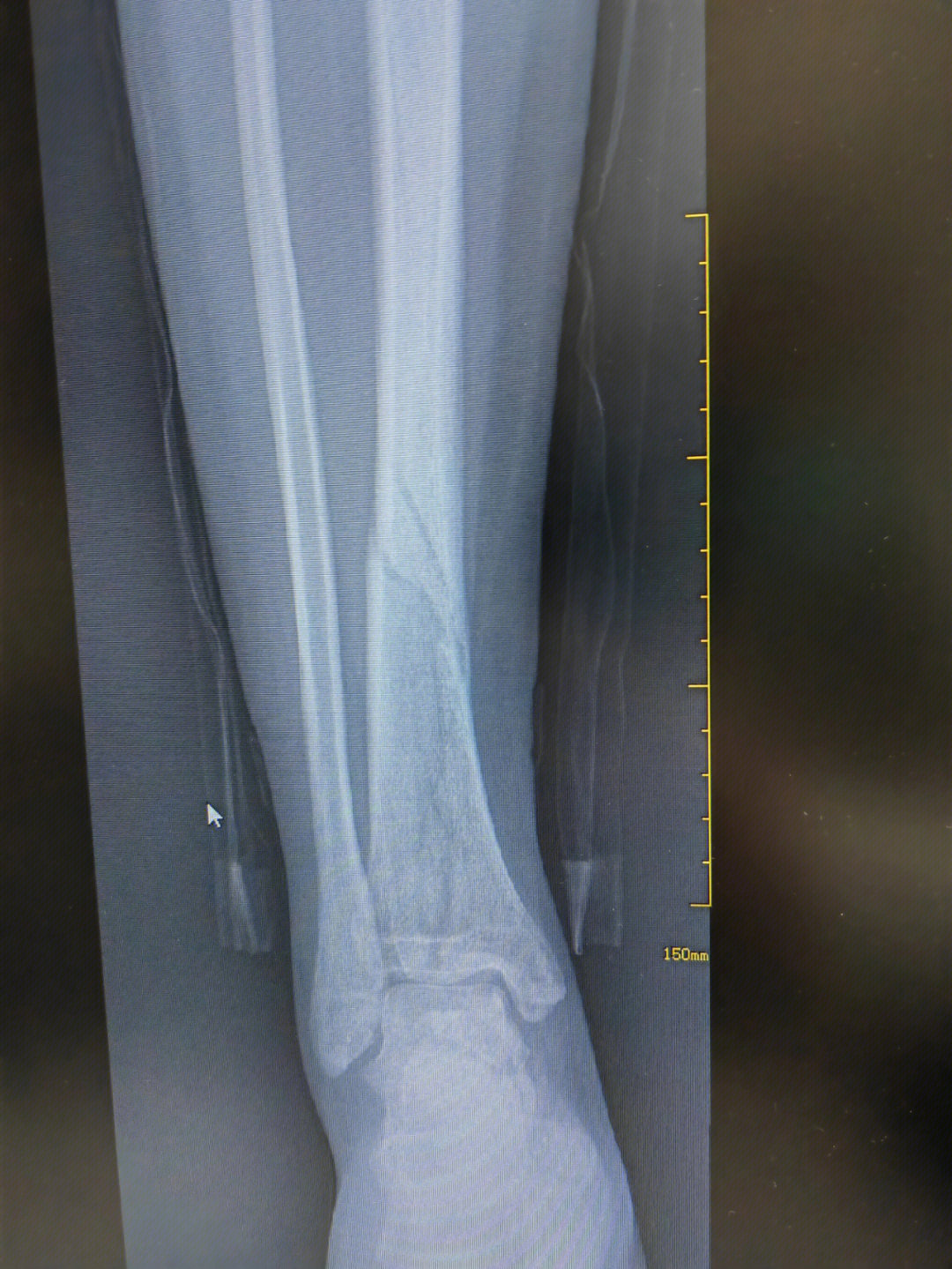 左胫骨下端骨折图片