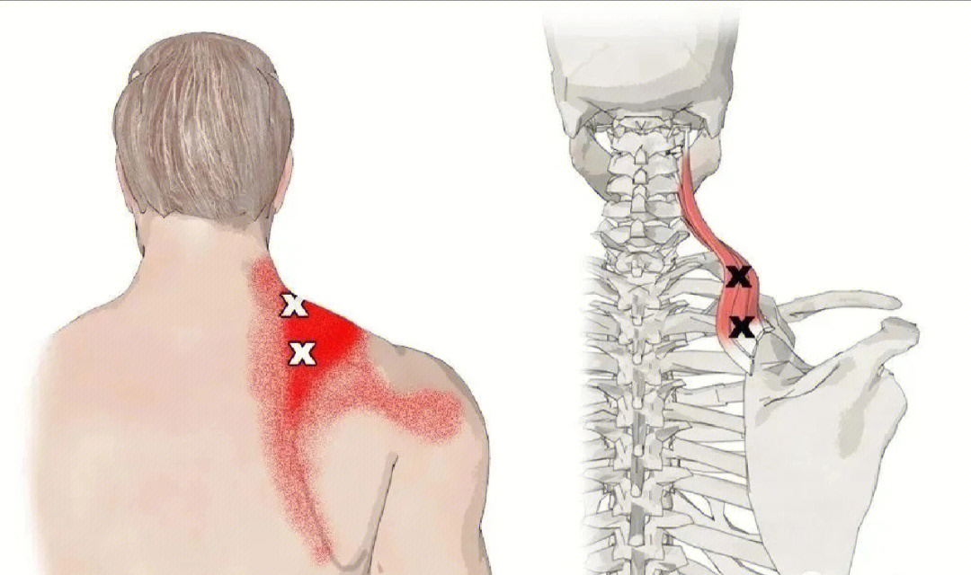 肩胛下区示意图图片