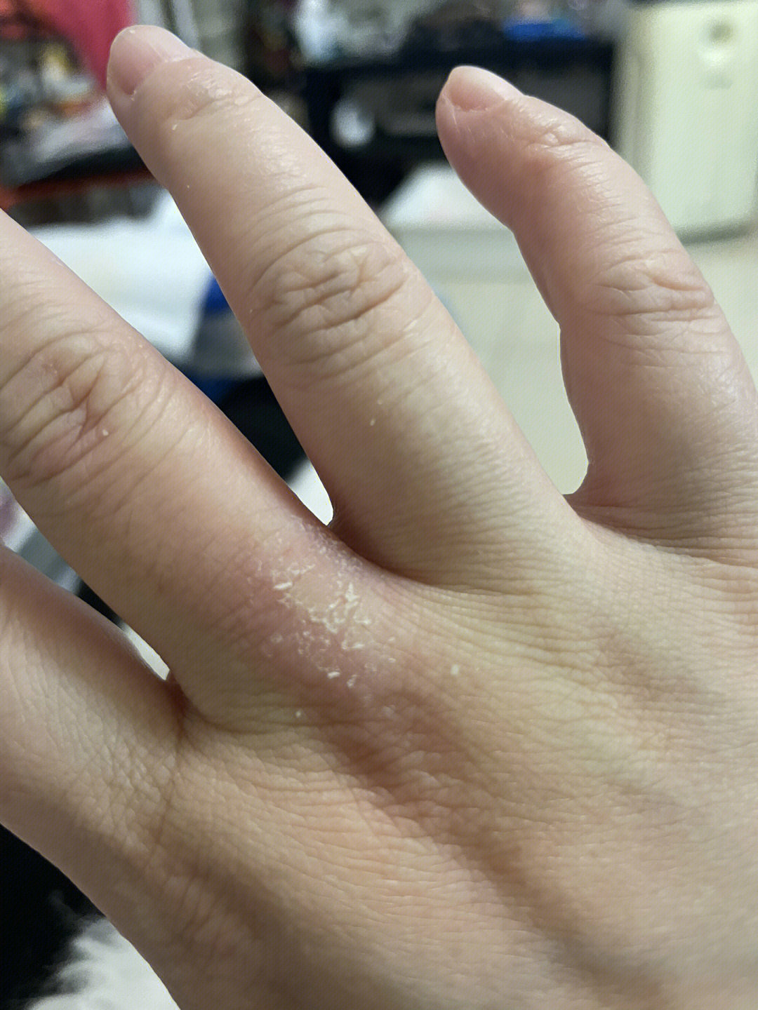 这个手藓问题困扰我近两年,中间好了个把月又反复开裂,只要是手洗了洗