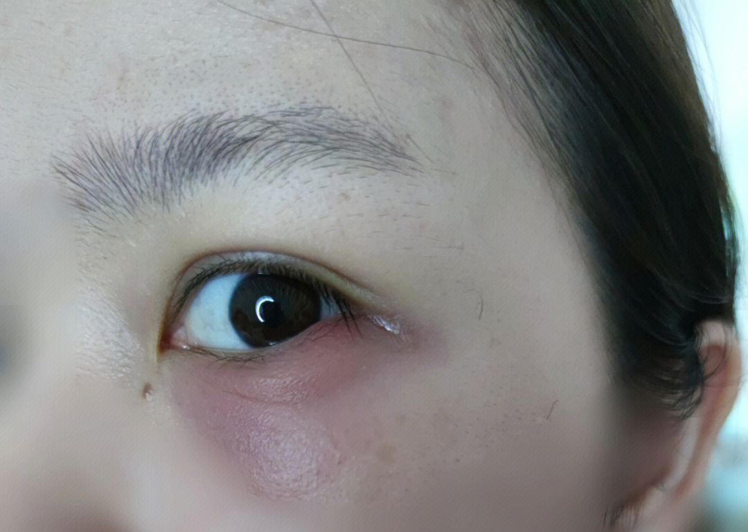 眼睑缘炎的症状及治疗图片