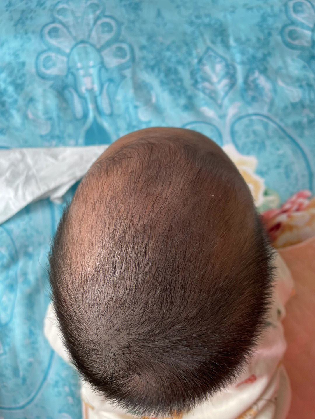 婴儿后脑勺枕骨沟图片图片
