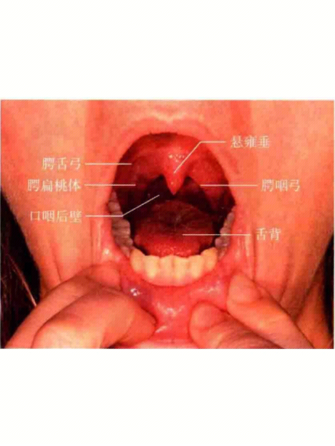 下颚扁桃体位置图片图片