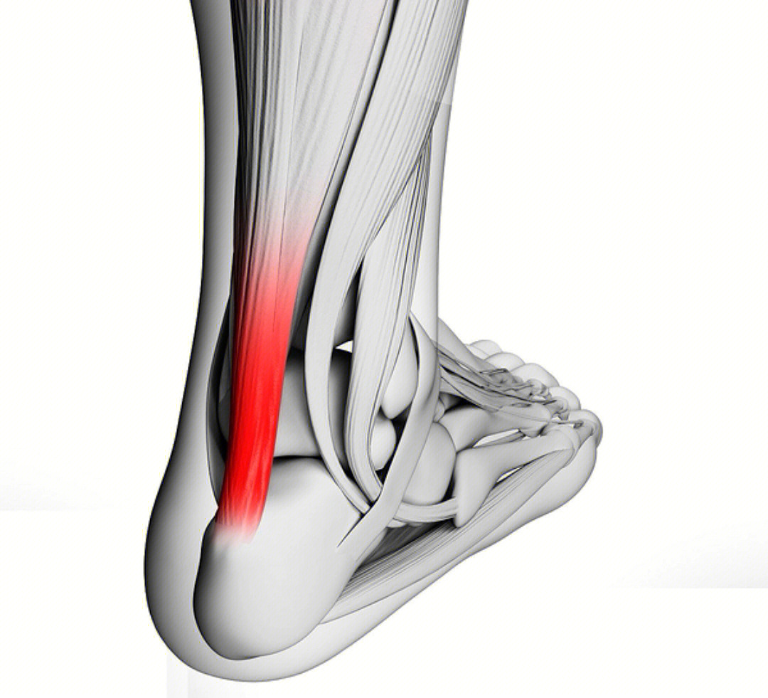 沃尔跟腱图片