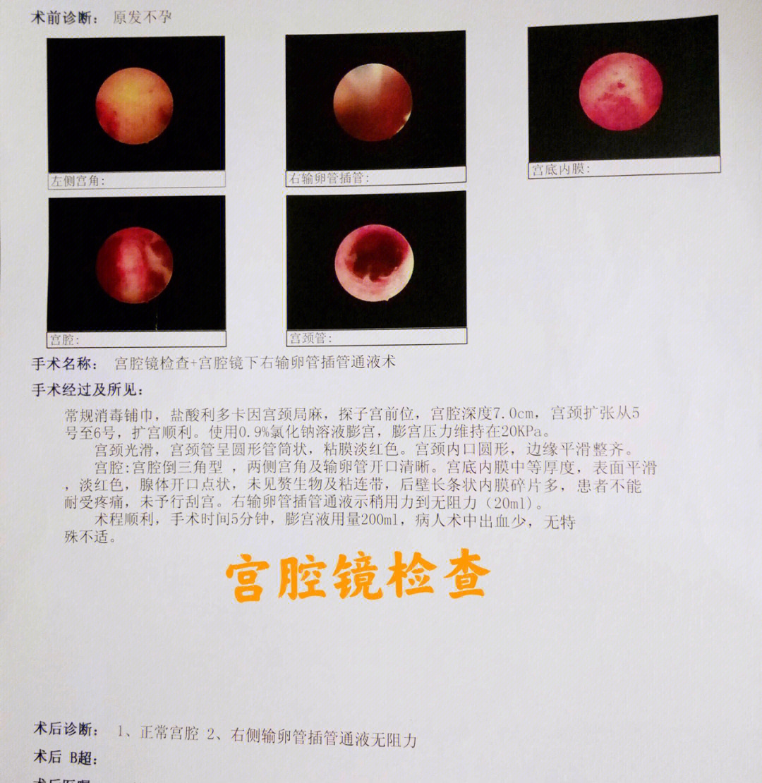 宫腔镜疼不疼图片