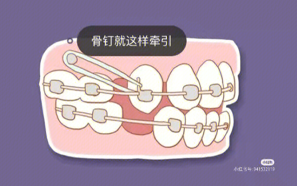 整牙打骨钉过程图解图片