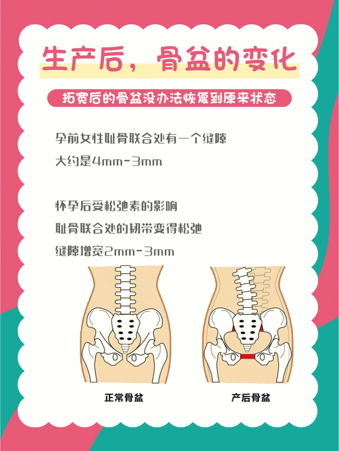 产后骨盆修复有必要吗图片