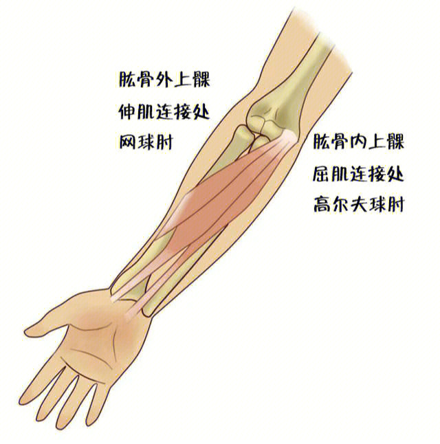 网球肘 解剖图图片