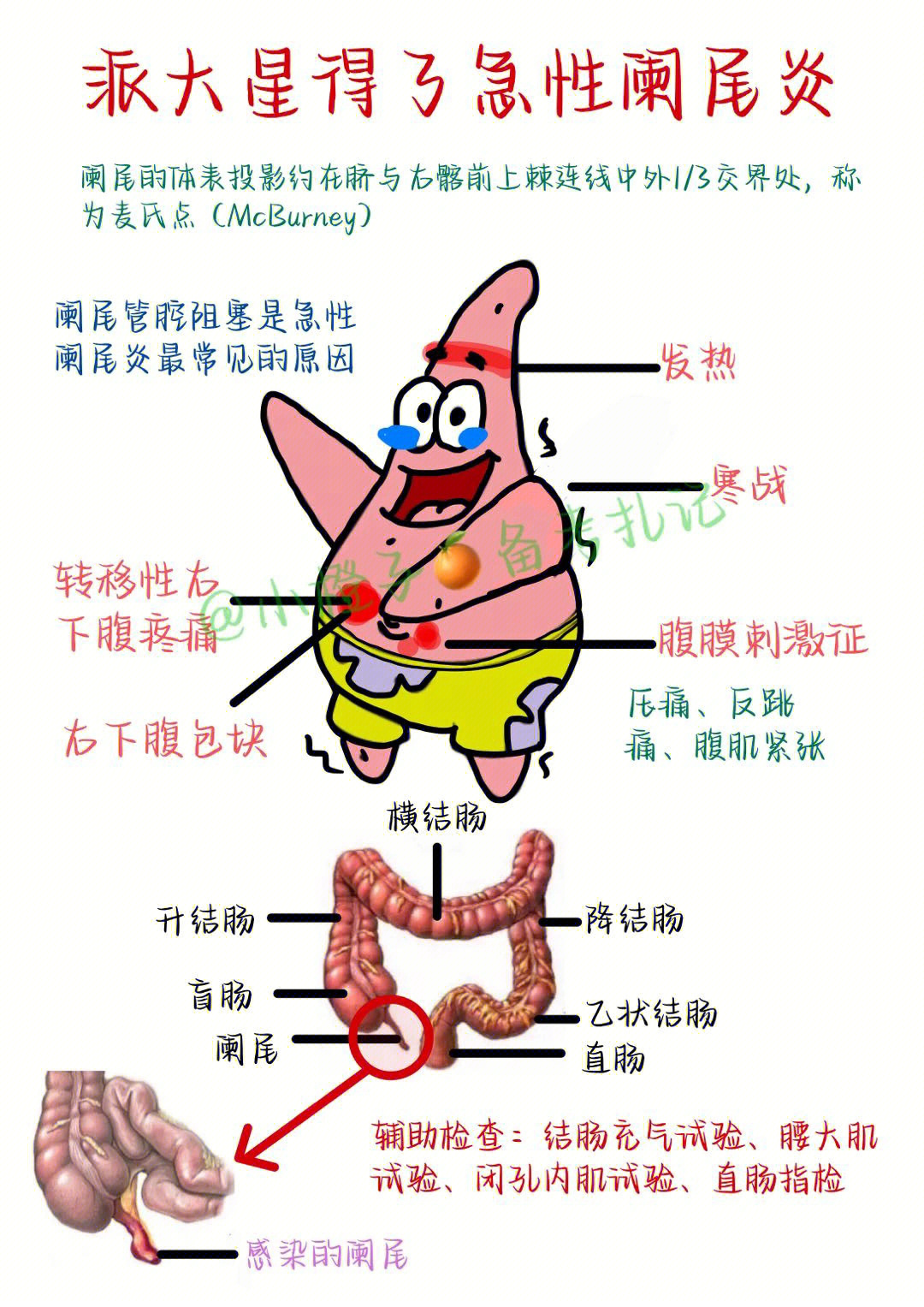 急性阑尾炎病理生理图图片