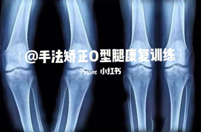 xo型腿骨骼拍片图解图片