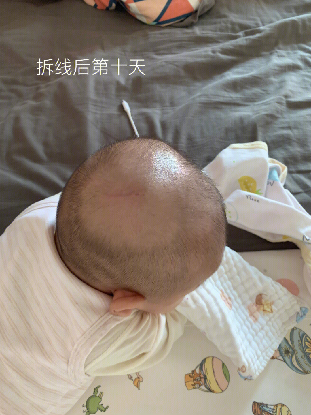 广东省内皮脂腺痣切除手术经验分享