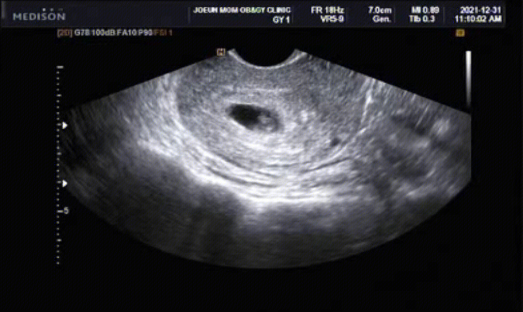 怀孕6周胎儿彩超图片图片