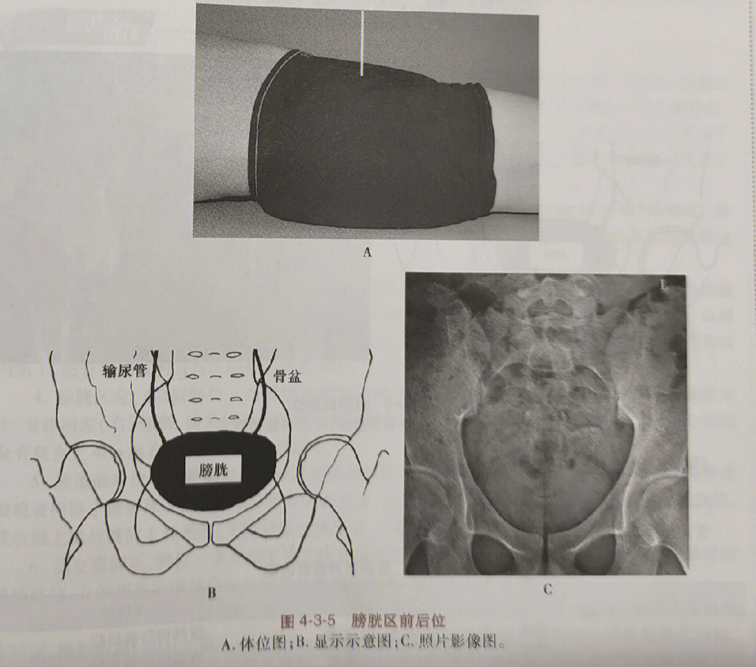 髂骨斜位拍摄方法图片图片