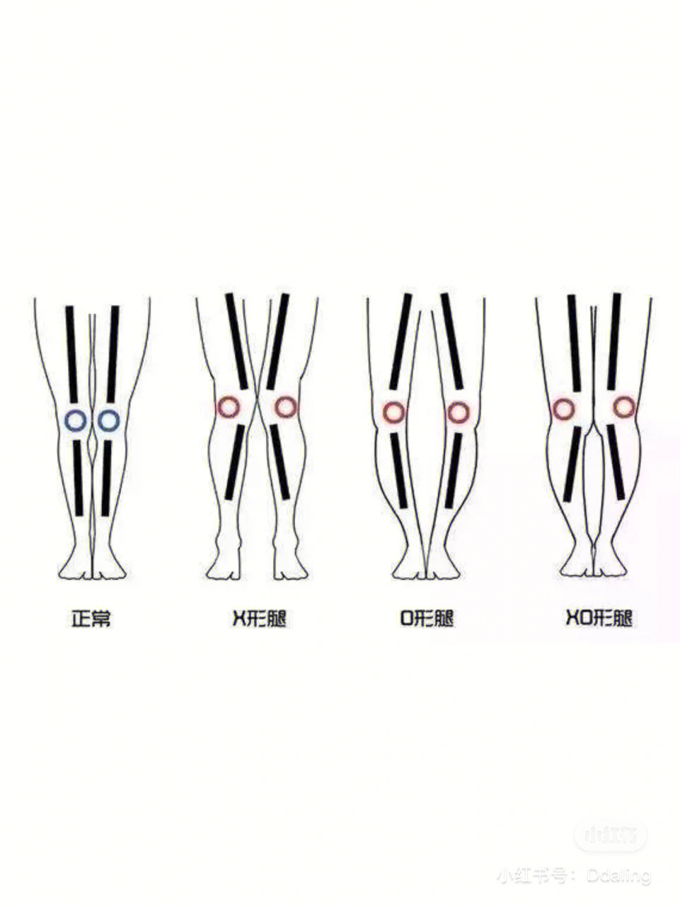 xo型腿形成原因图解图片