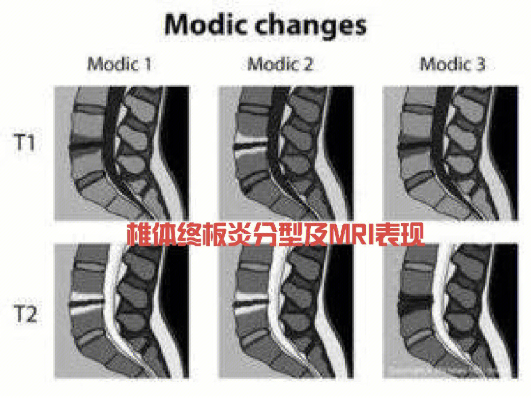 什么是终板炎图片