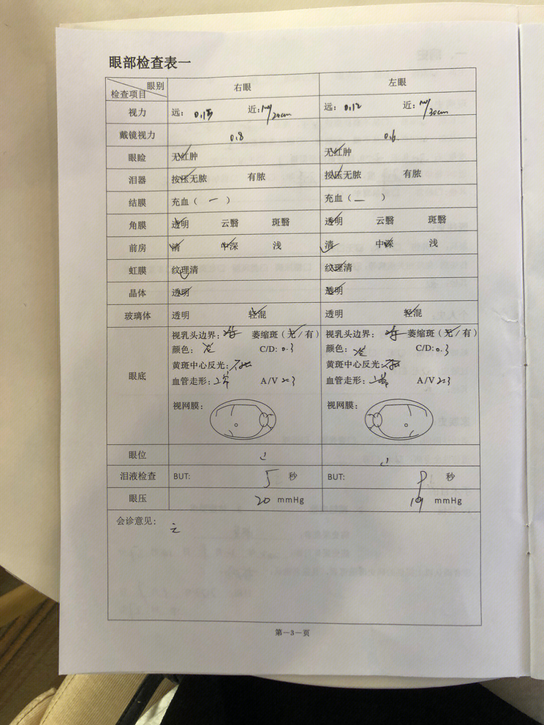 泪膜破裂时间图片