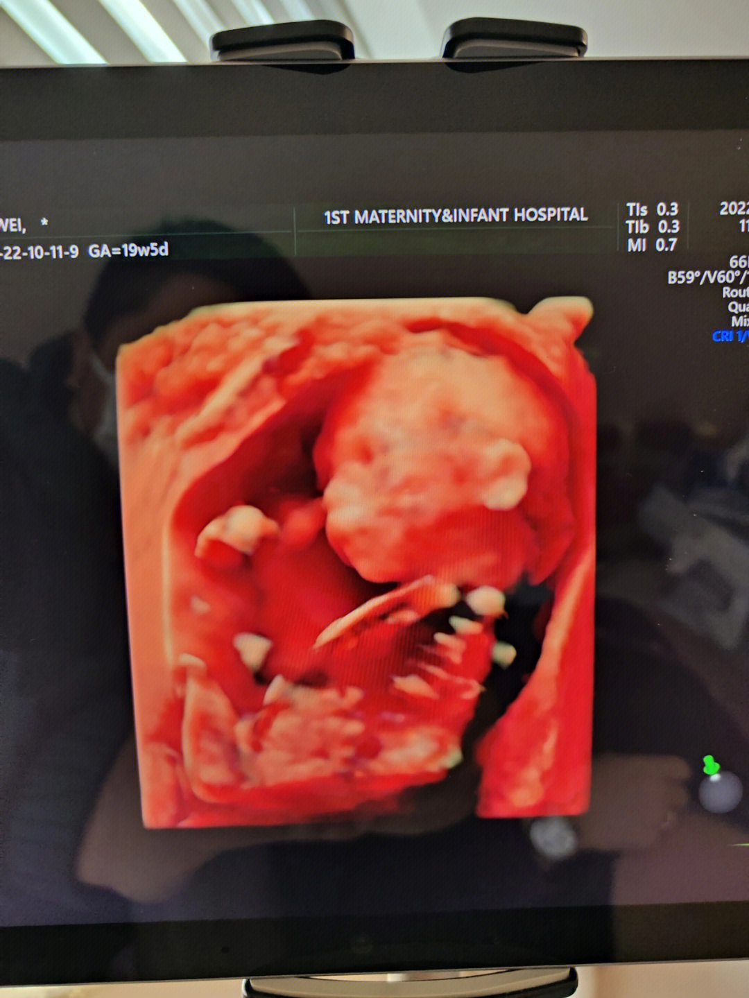 怀孕19周胎儿彩超图图片