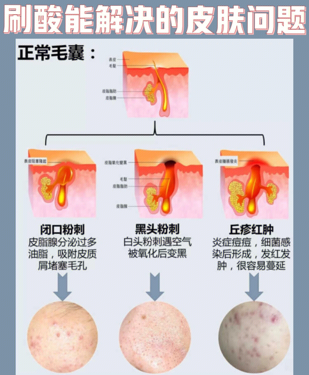 毛囊炎怎么根治图片