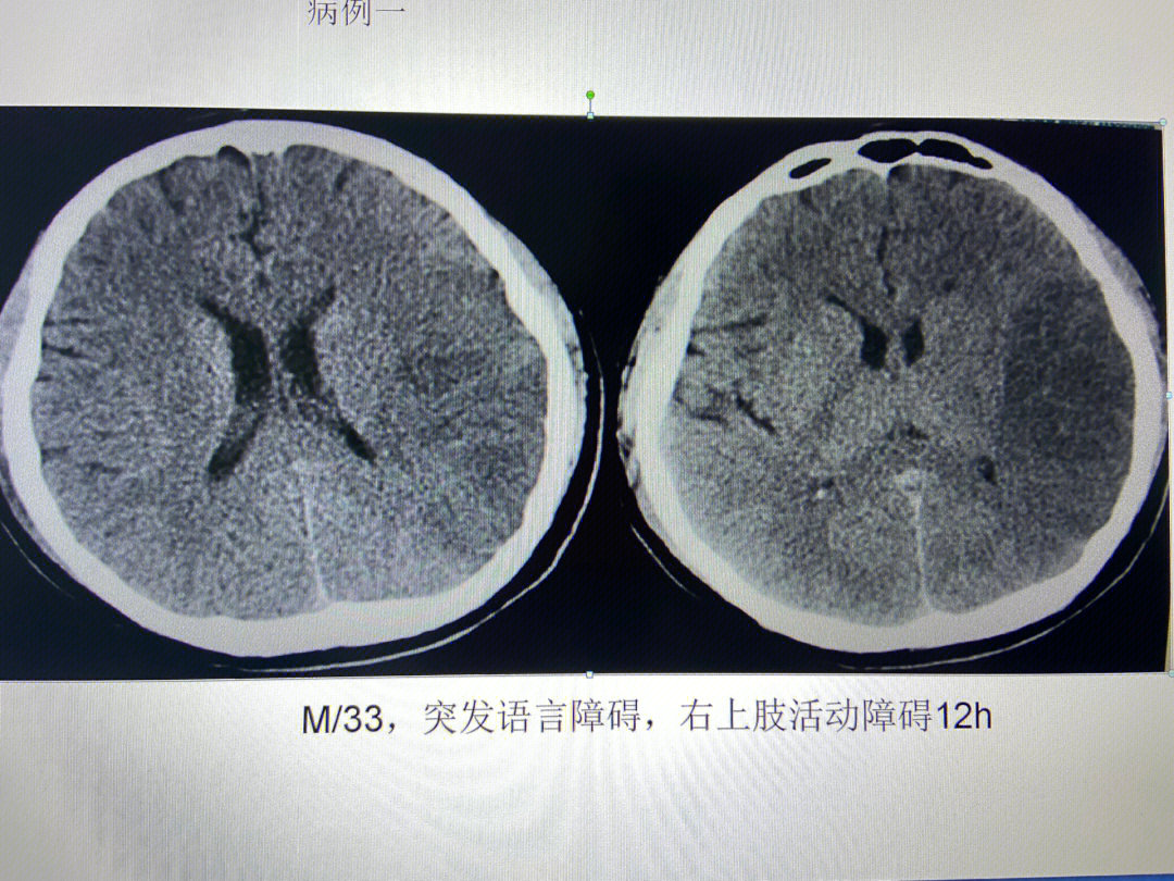 病例一  左侧颞叶脑梗死病例二  左侧脑室穿通畸形 软化灶病例三