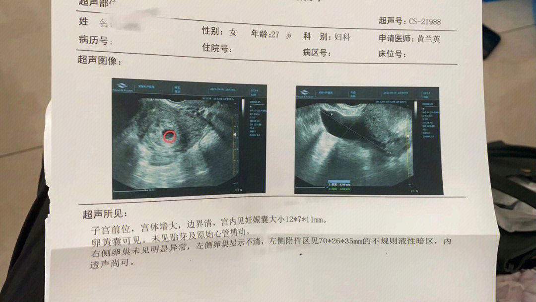 巧克力囊肿可以怀孕吗图片