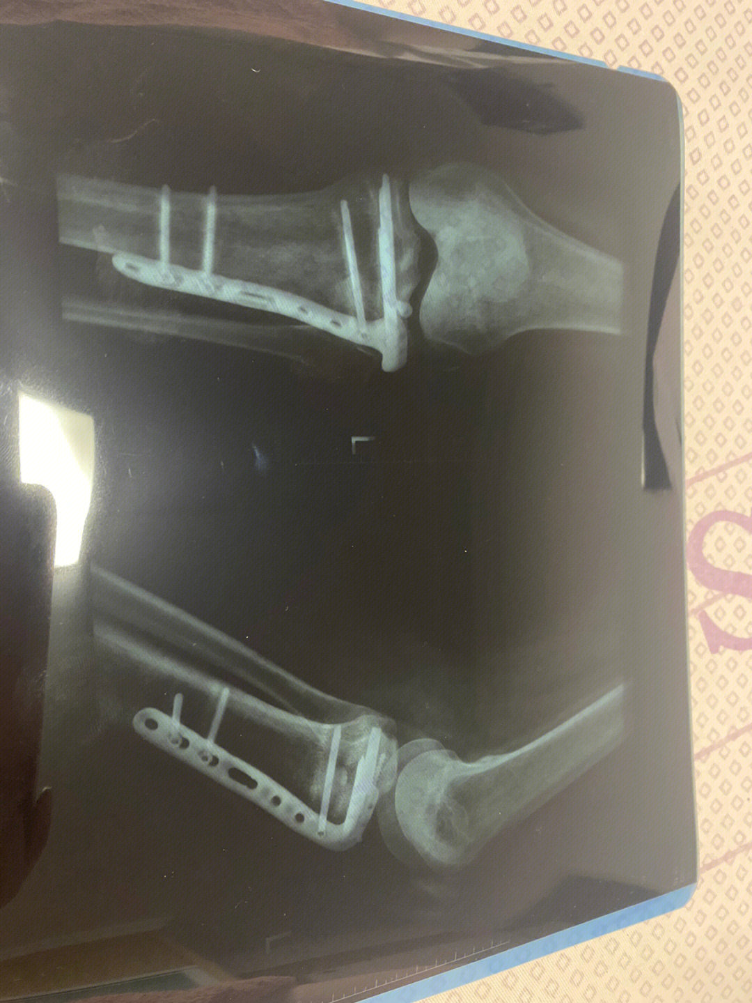 骨折骨痂图片一个月图片