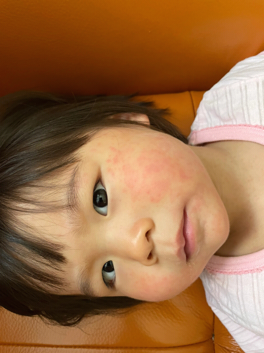 儿童花粉过敏症状图片图片