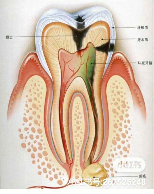 慢性牙髓炎怎么治疗图片