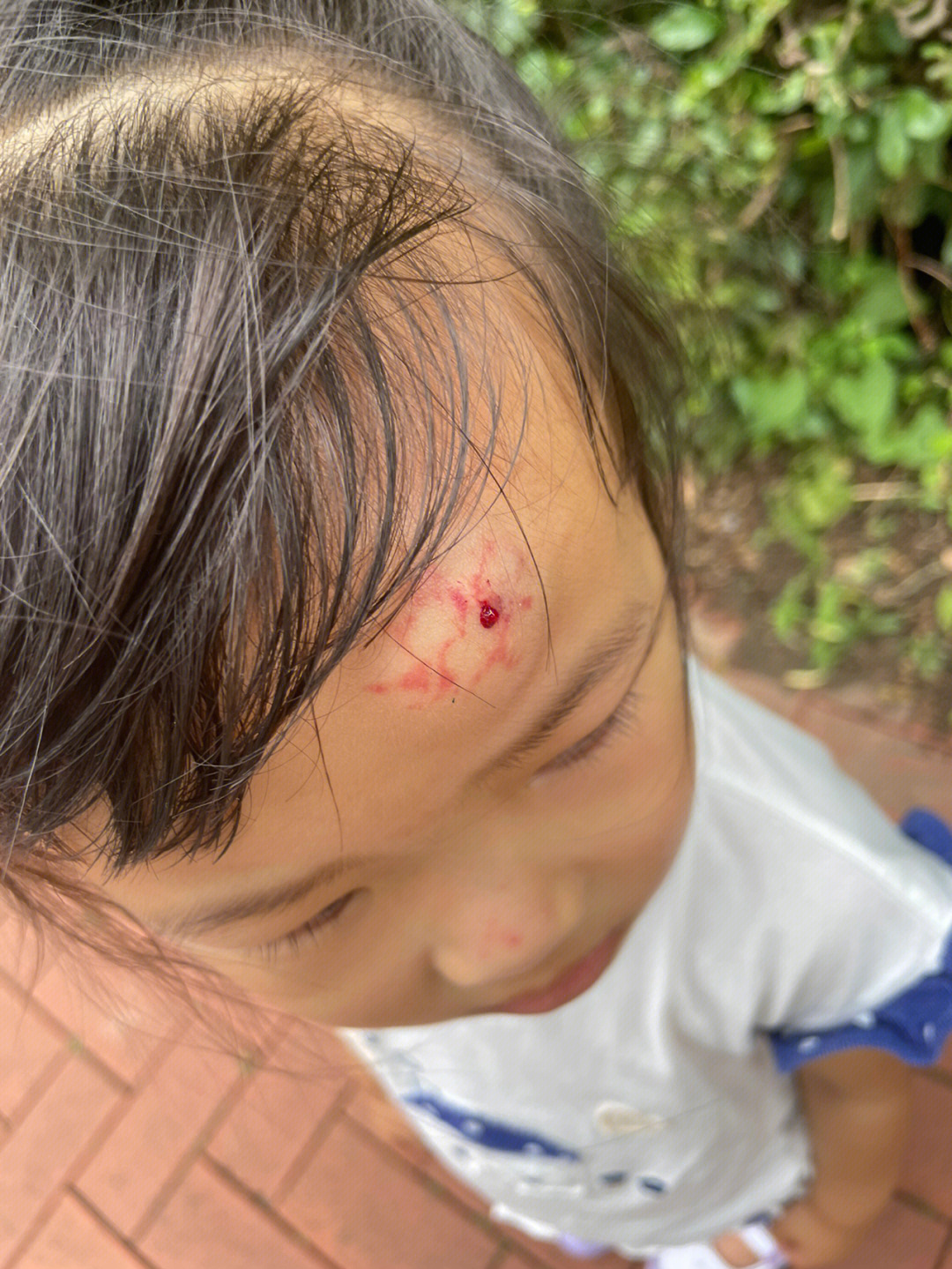 小女孩今天早上去幼儿园的路上,把额头摔了一个特别大的血包.