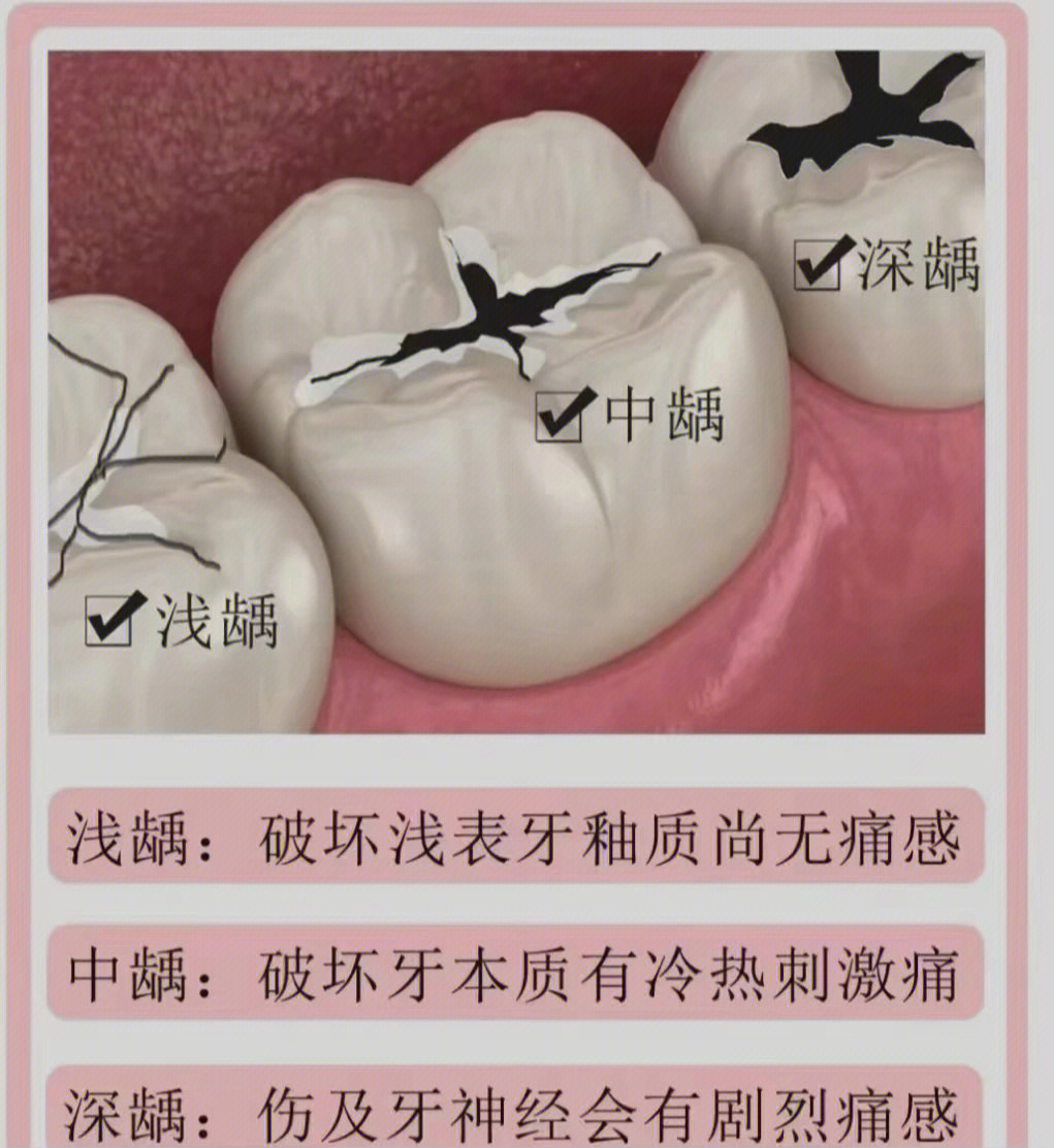 补牙,只能修复普通虫牙67食物残渣遗留在窝沟和牙缝之间67产生