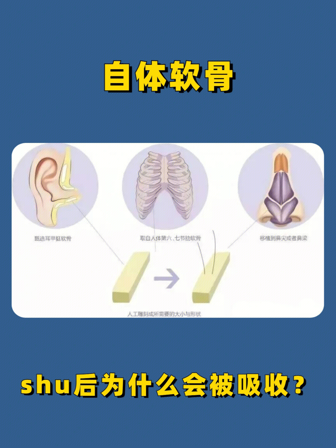 耳软骨是一种弹性软骨,取耳软骨做鼻z合时,需要的养分较多,shu后支撑