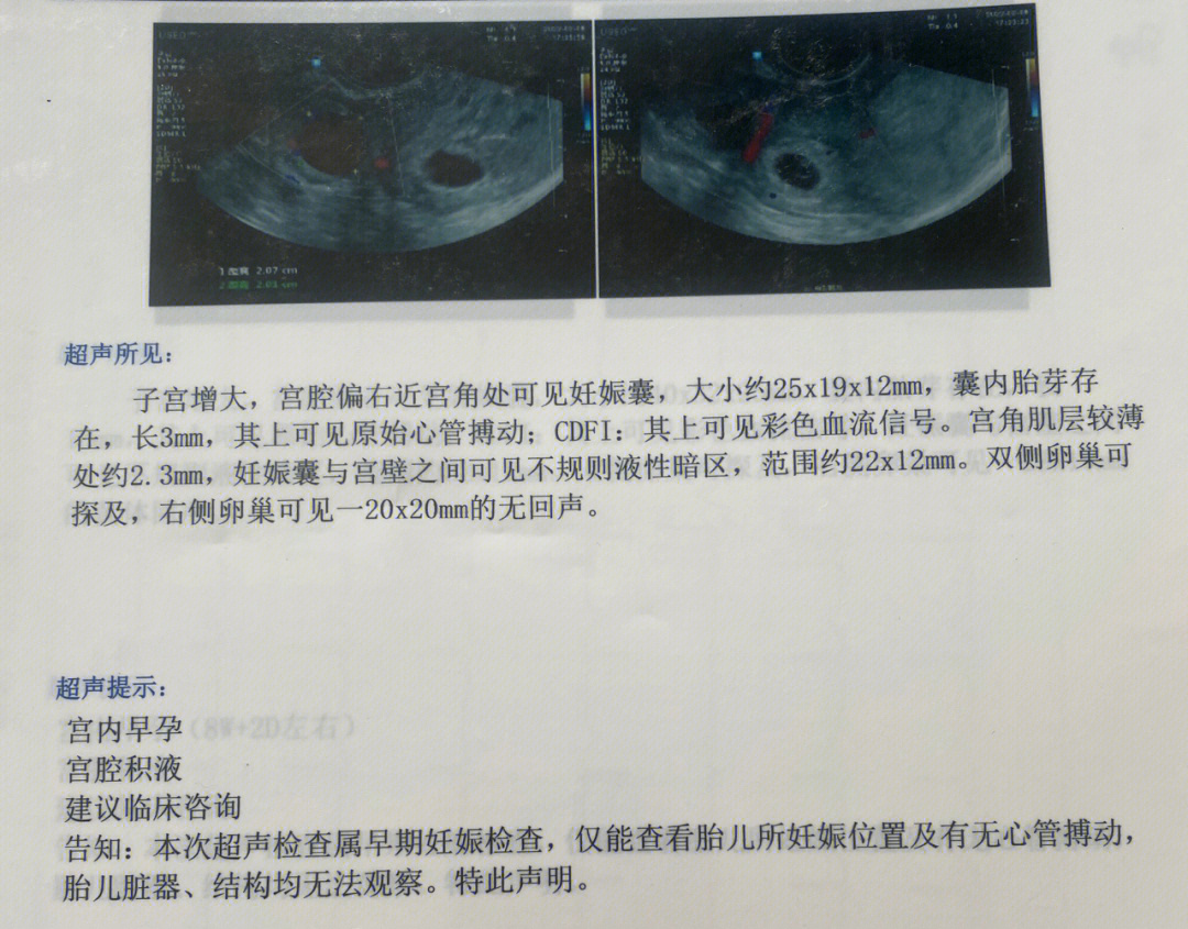 妊娠线偏左偏右示意图图片