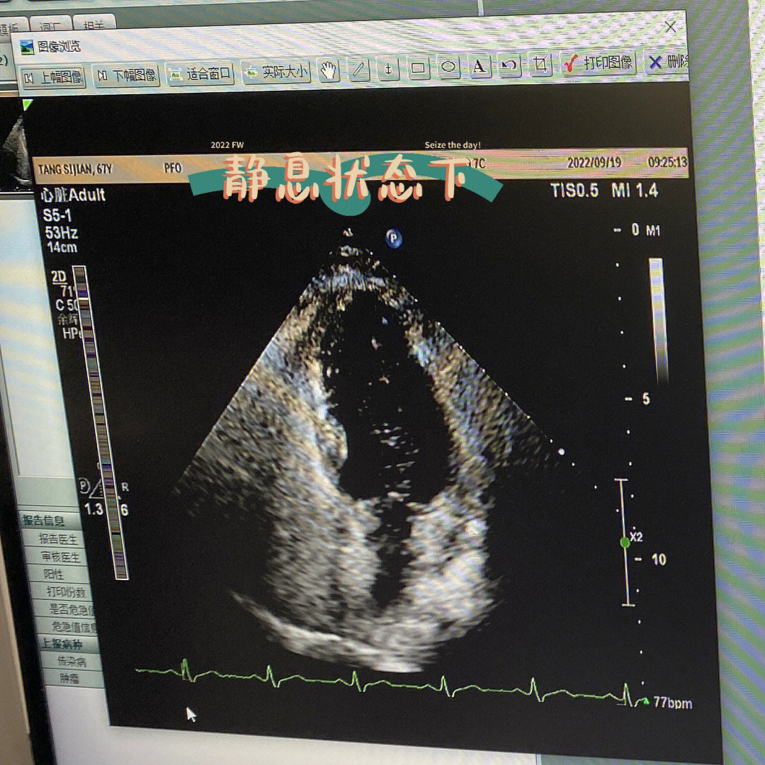 第一次看心脏超声造影,也就是常说的发泡实验,以前只知道ct和mri可以
