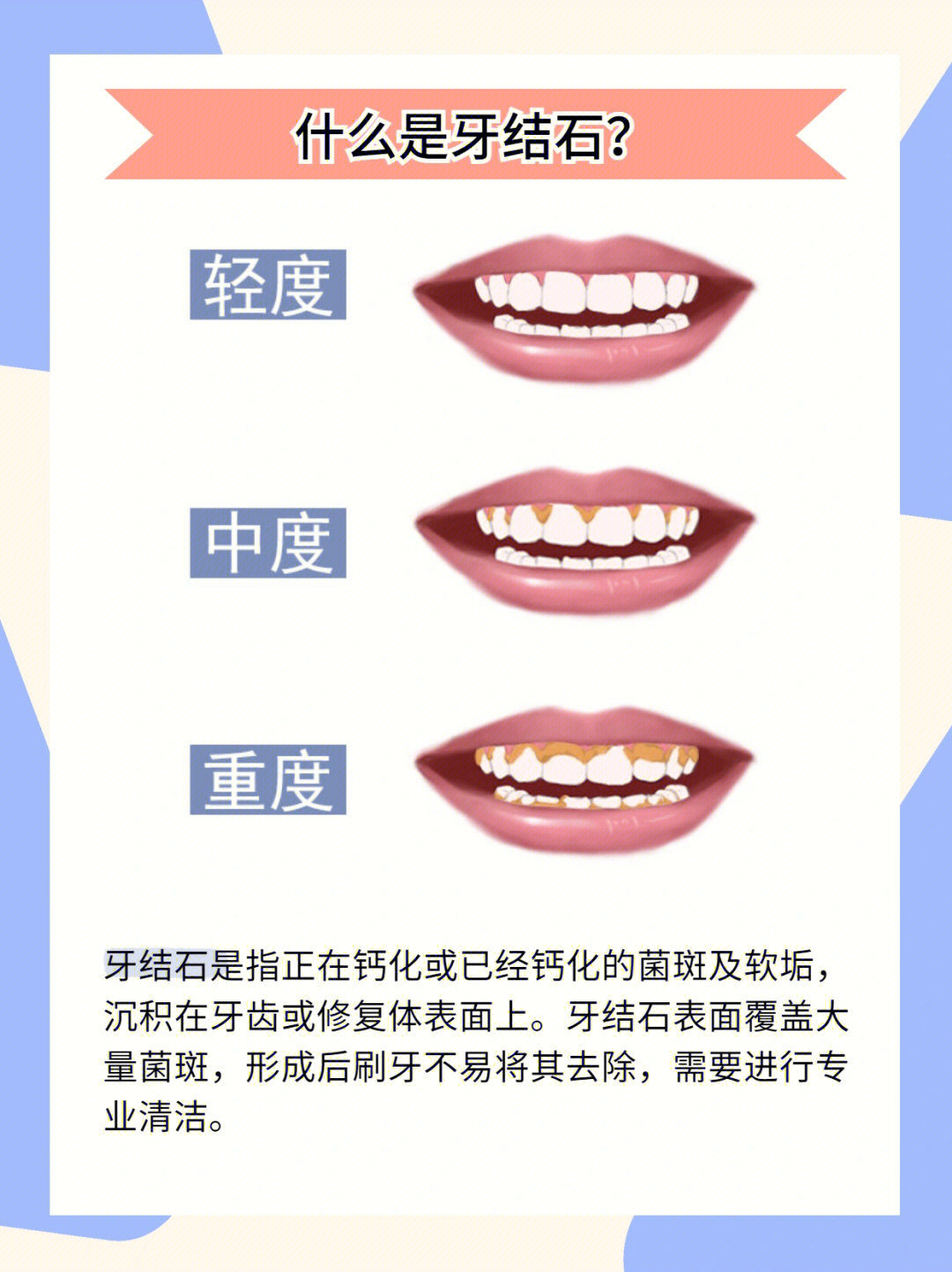 牙结石严重程度示意图图片