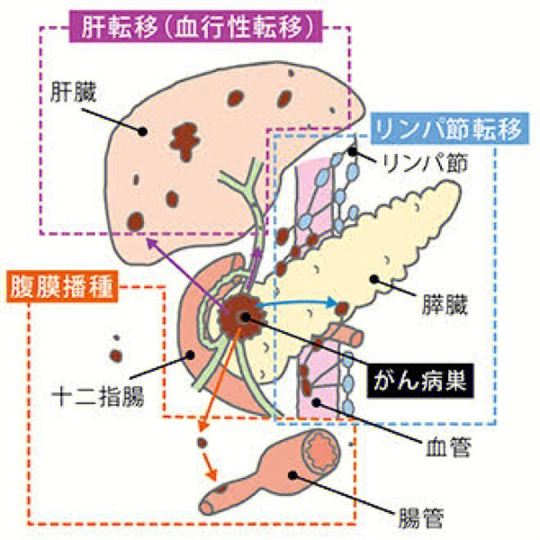 胰头癌示意图图片