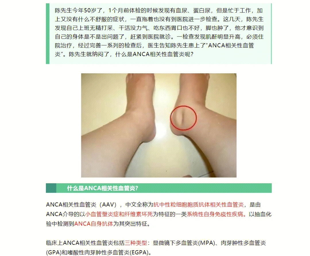 什么是anca相关性血管炎上篇