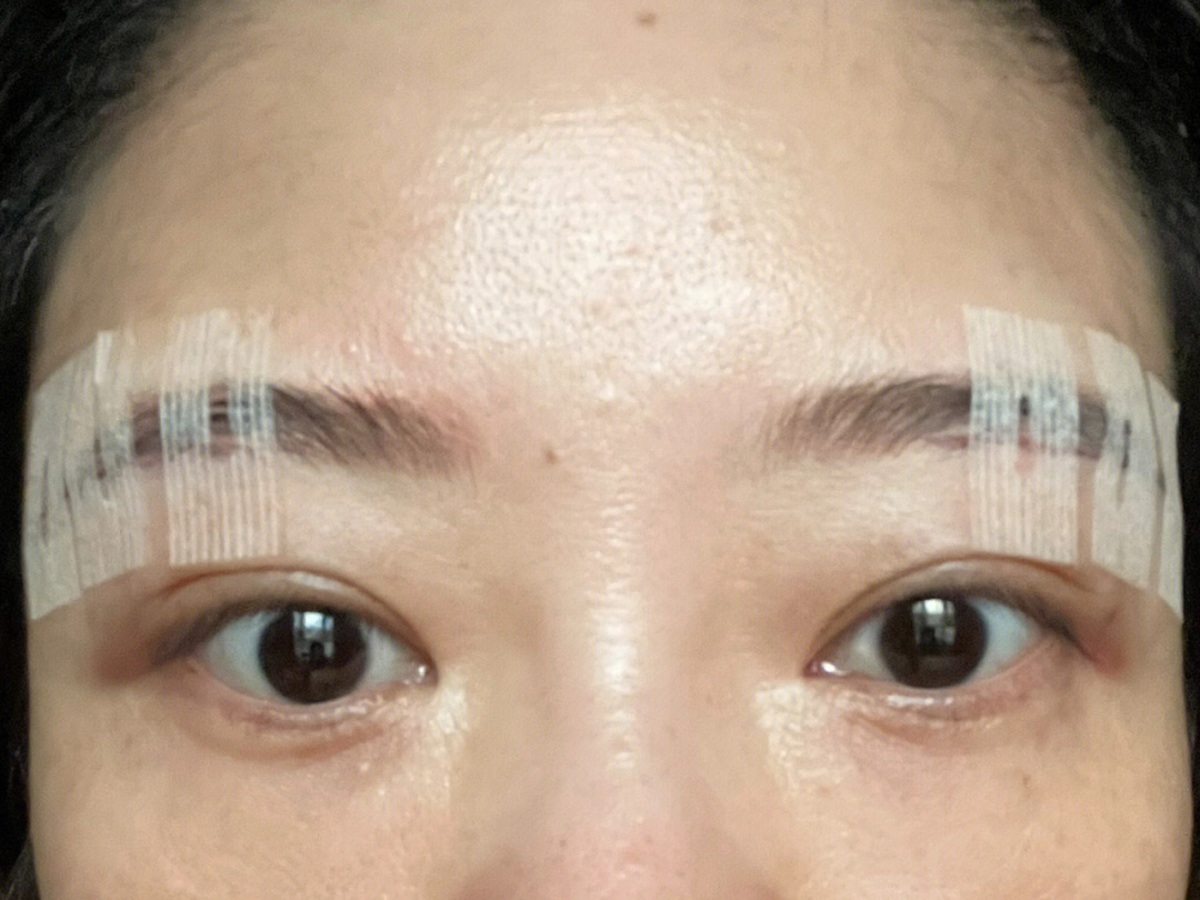 眉上切口的恢复过程图图片
