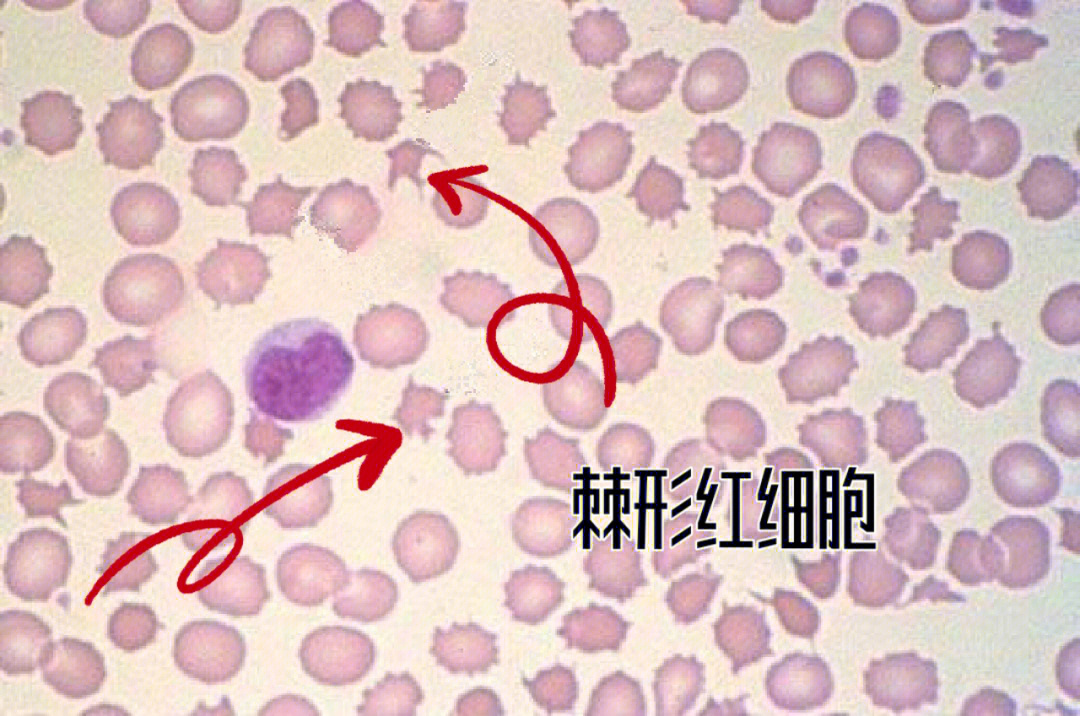 锯齿红细胞图片