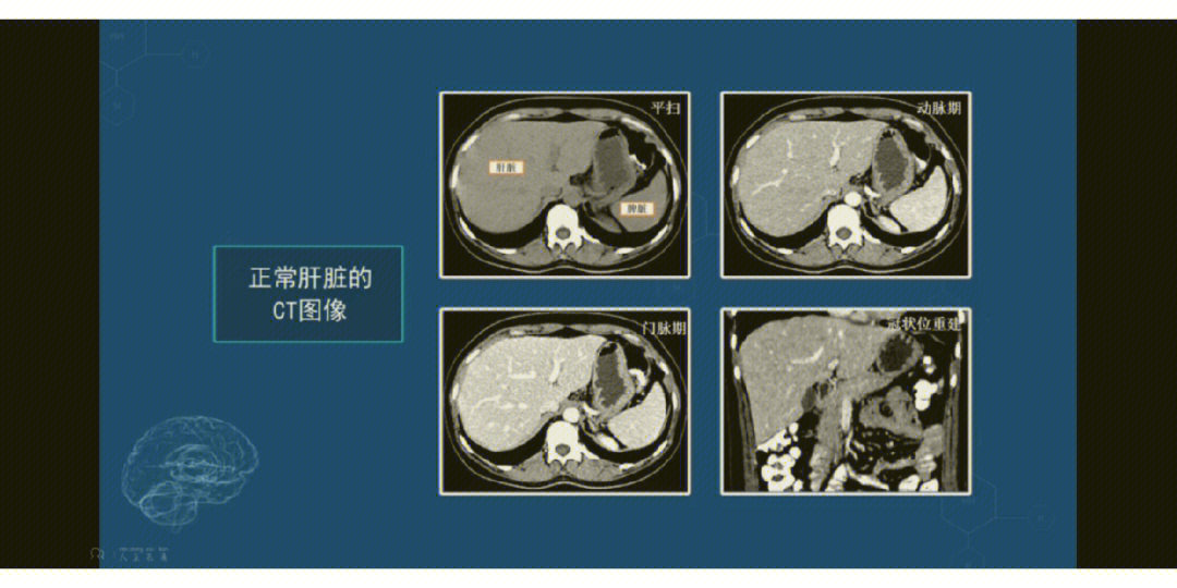 正常肝ct图片怎样看图片