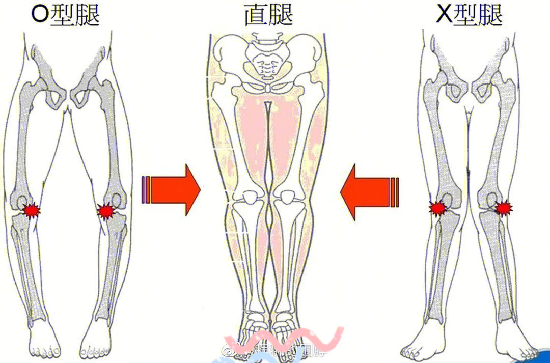 xo型腿形成原因图解图片