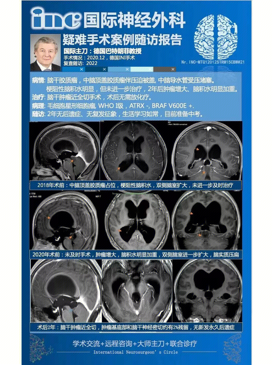 得了这种胶质瘤能活50年