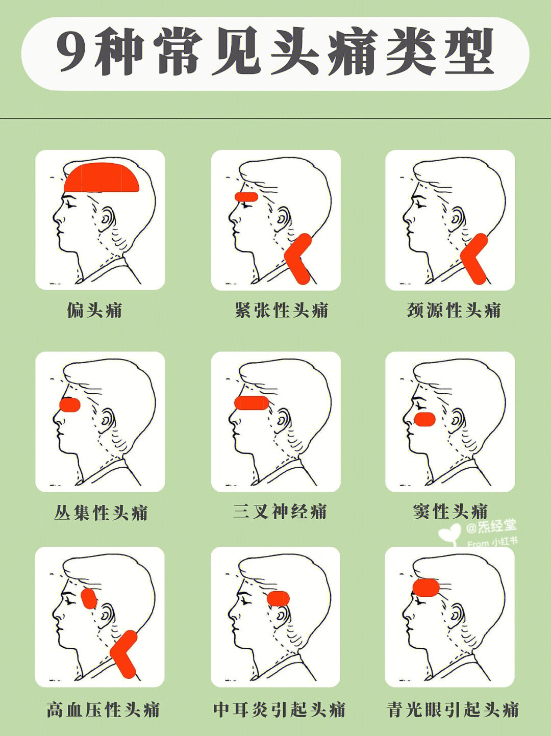 常见的头痛类型图片图片
