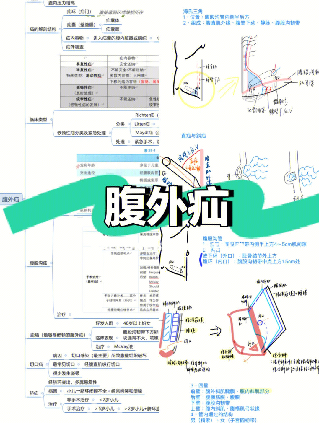 外科学腹外疝思维导图笔记画图