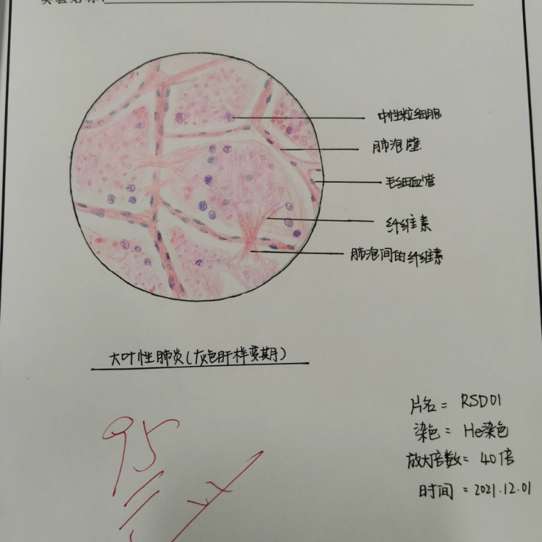 病理红蓝绘图鼻息肉图片