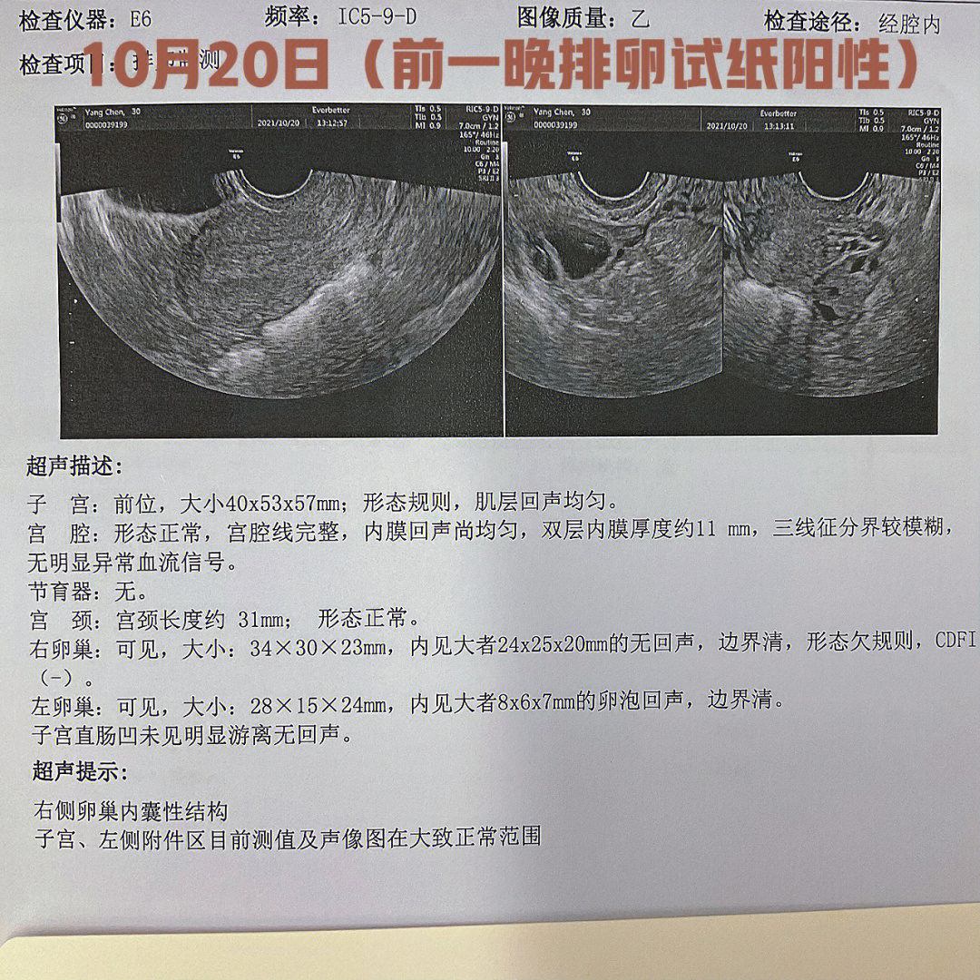 卵丘超声图片图片