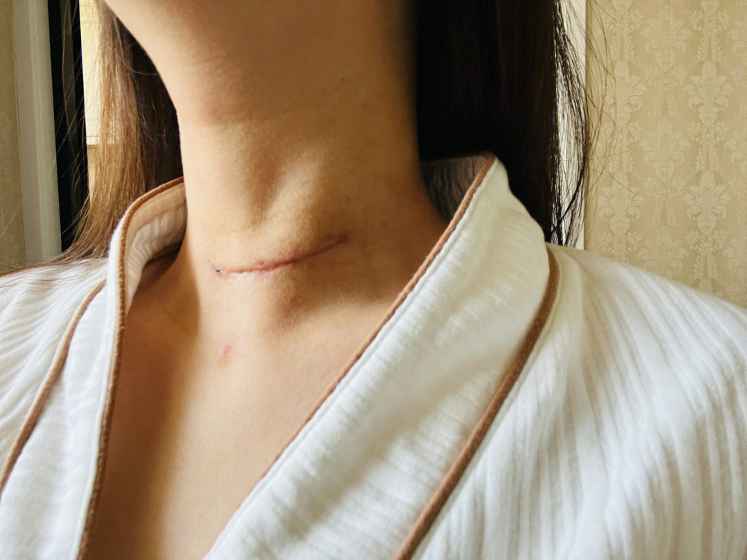 记录甲状腺疤痕去疤的过程