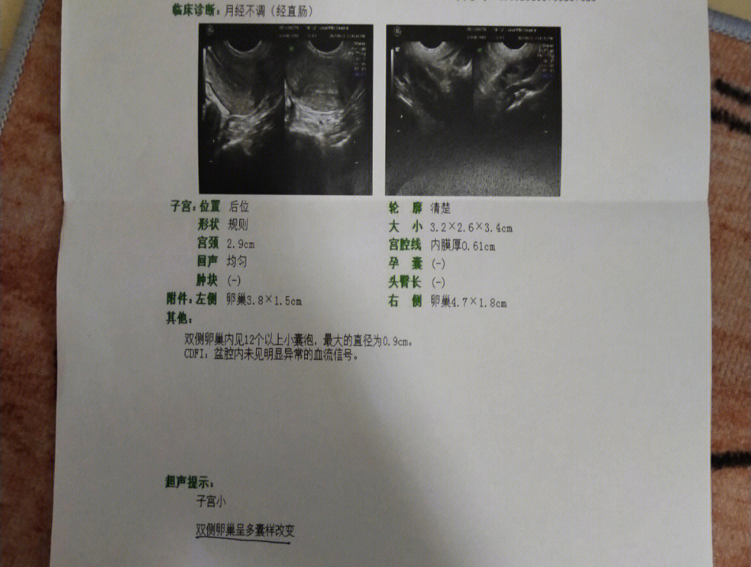 多囊卵巢综合症化验单图片