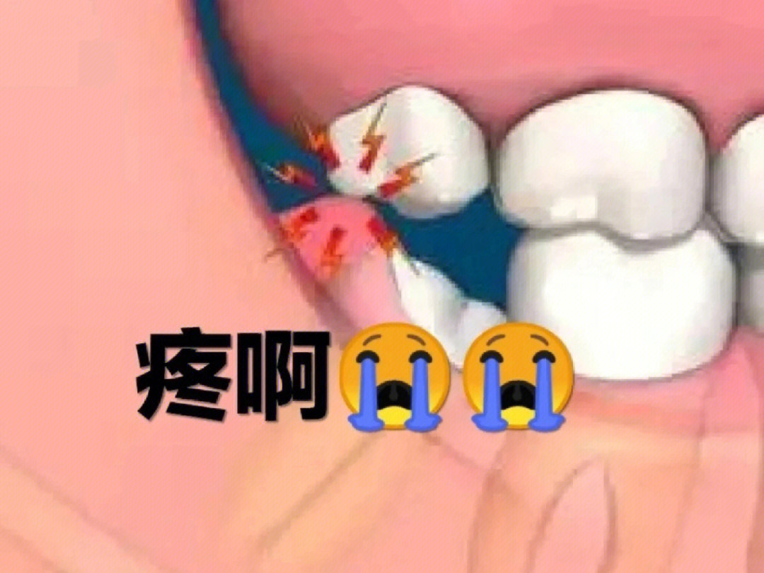 牙龈盲袋图图片