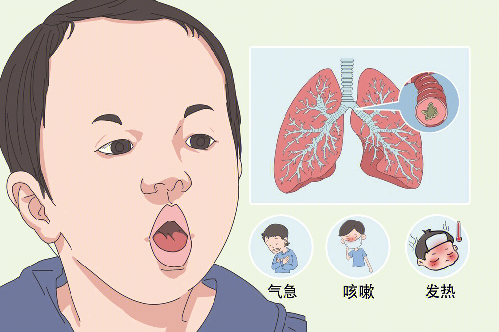 小儿急性支气管炎上部