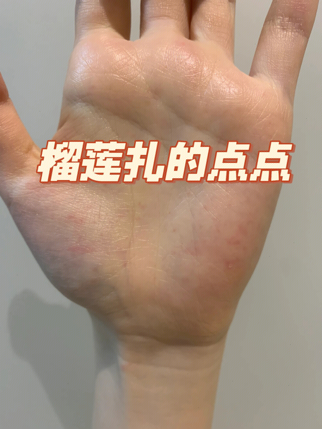 手被扎成这样挑到的榴莲